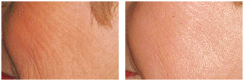 Up-close image of woman's cheek area, showing before and after results from Laser Skin Tightening.