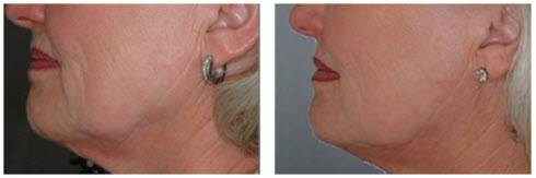 Up-close image of woman's cheek area, showing before and after results from Laser Skin Tightening.