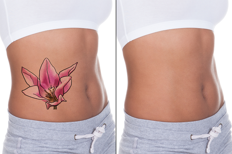 Understanding the Laser Tattoo Removal Process - Calista Skin & Laser (DFW)