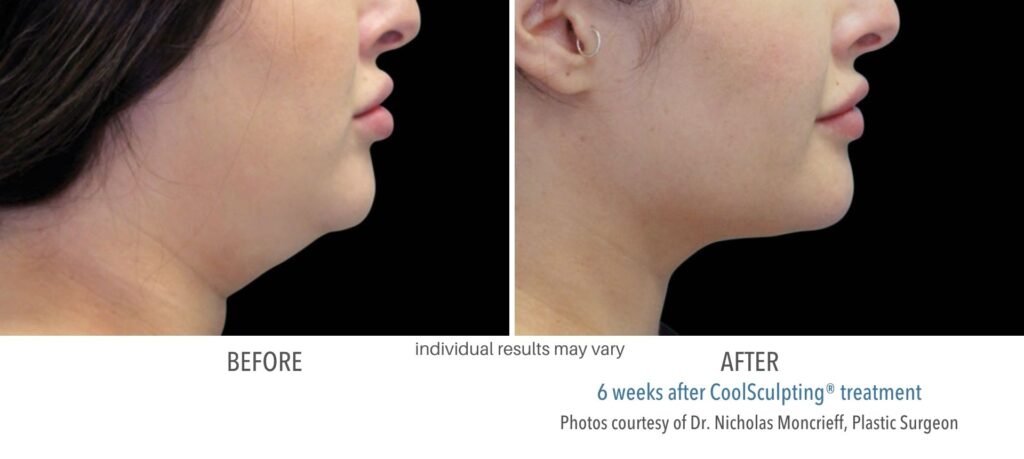 Woman's chin showing the results before and after Coolsculpting, over six weeks.
