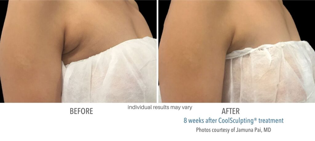 Woman's under arm and side breast showing the results before and after of Coolsculpting, over 8 weeks.