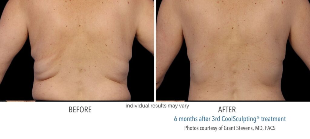 Man's flanks showing the results before and after of Coolsculpting, over 6 weeks.