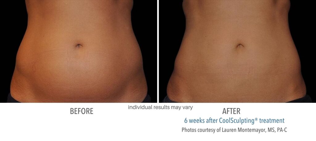 Woman's belly showing the results before and after of Coolsculpting, over 6 weeks.