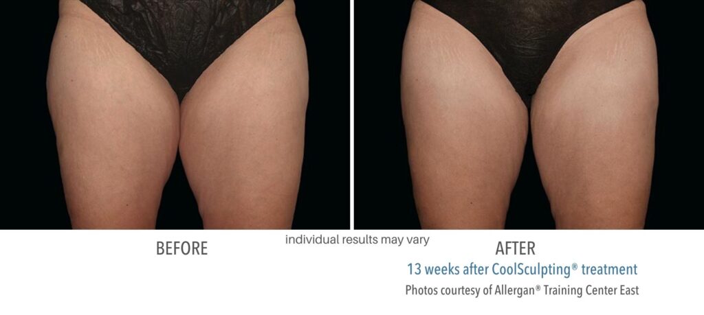 Woman's upper thighs showing the results before and after of Coolsculpting, over 13 weeks.