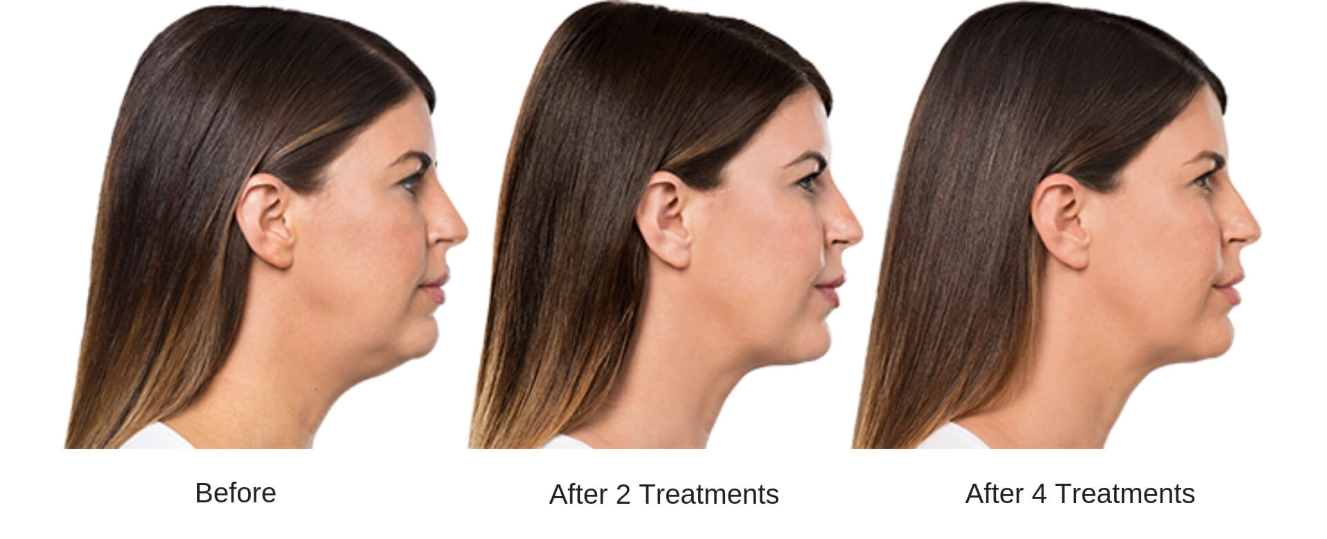 Woman's side profile showing the progression of results of before, after two treatments, and after four treatments of a Kybella series.