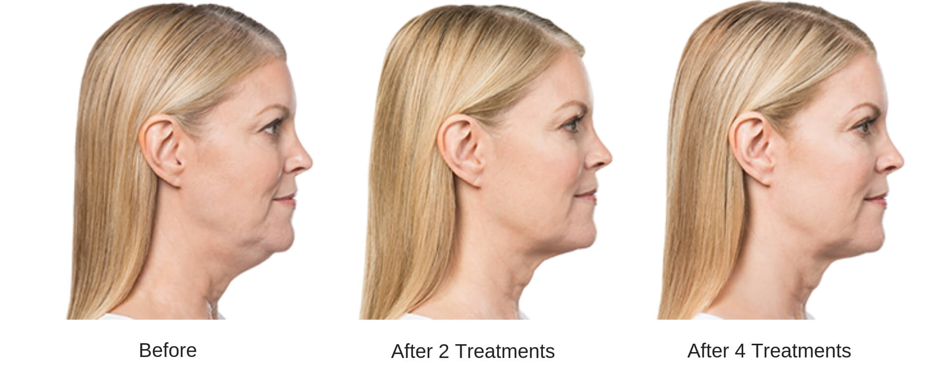 Woman's side profile showing the progression of results of before, after two treatments, and after four treatments of a Kybella series.