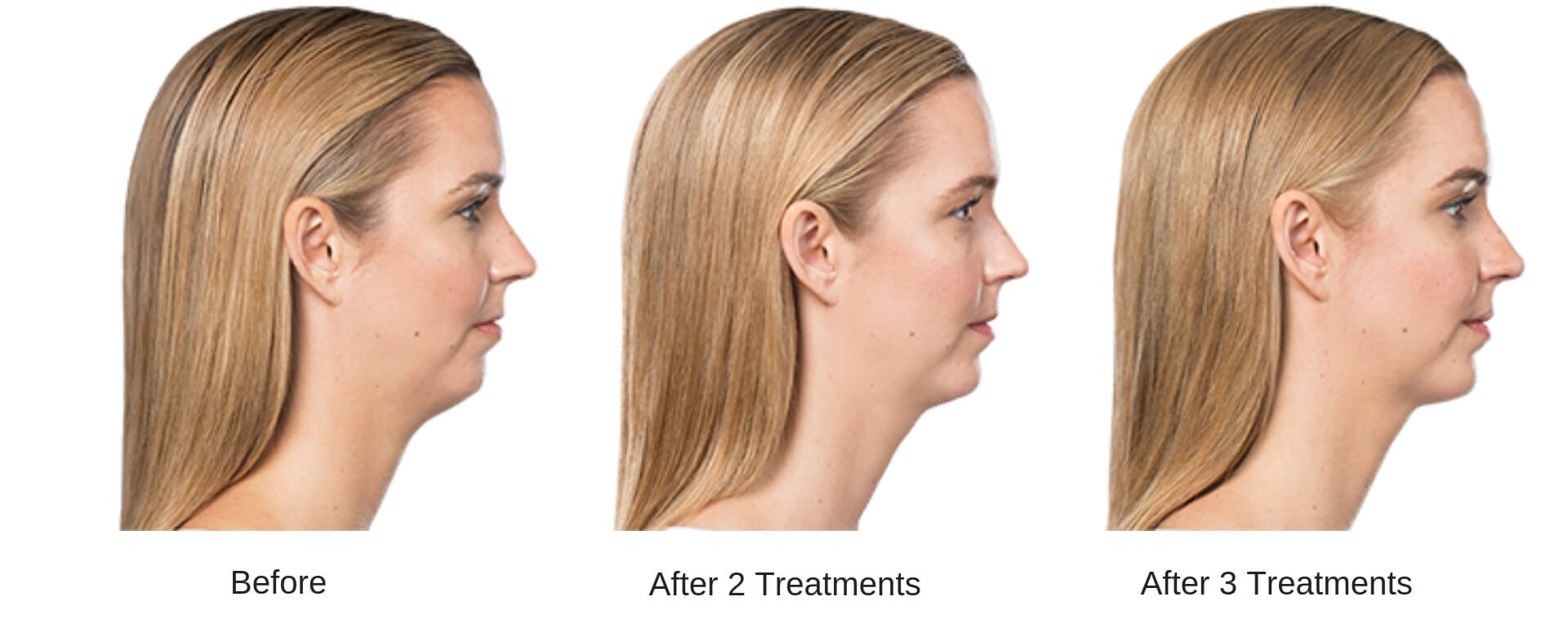 Woman's side profile showing the progression of results of before, after two treatments, and after three treatments of a Kybella series.