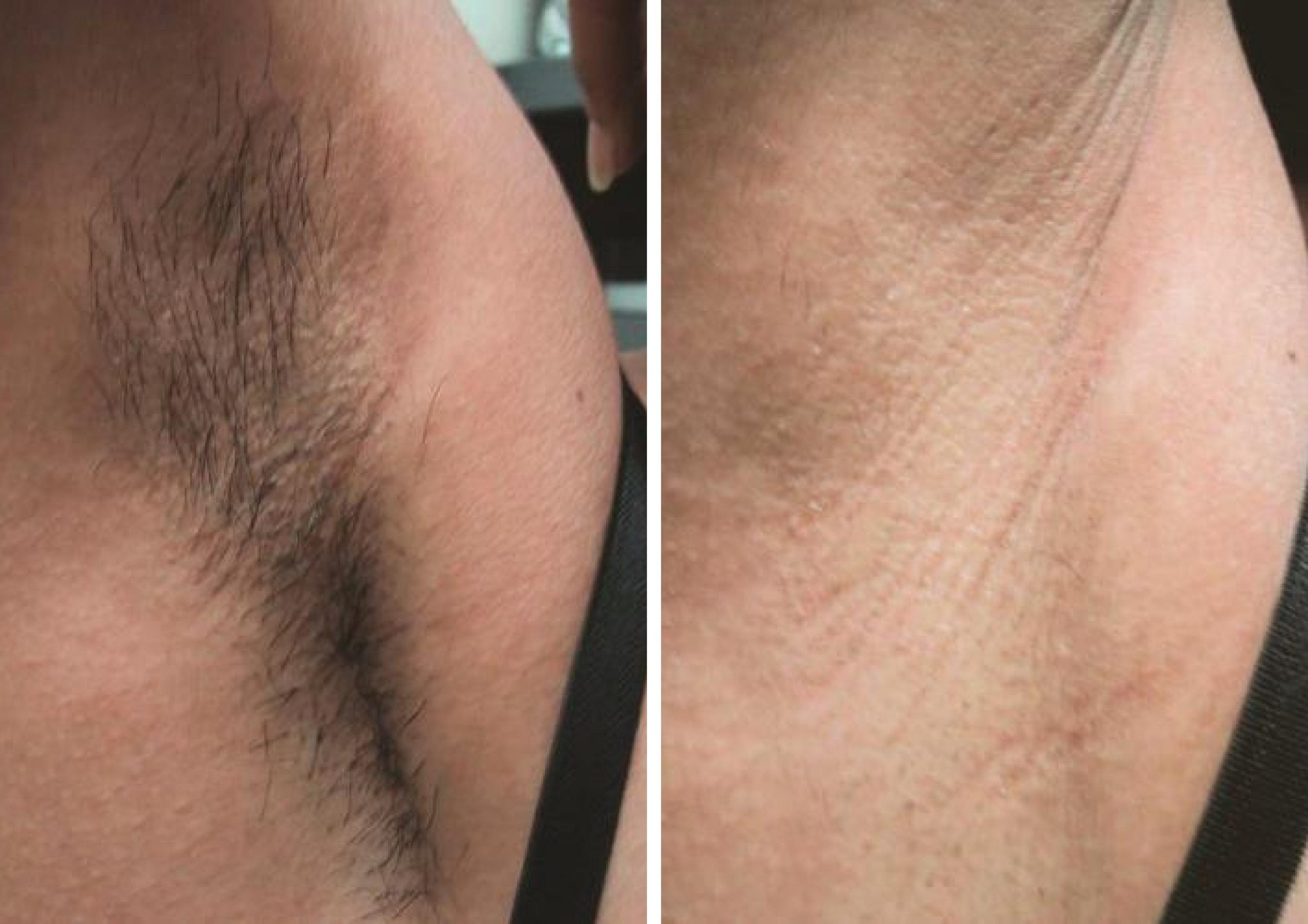 Laser Hair Removal before and after treatment to armpit area.