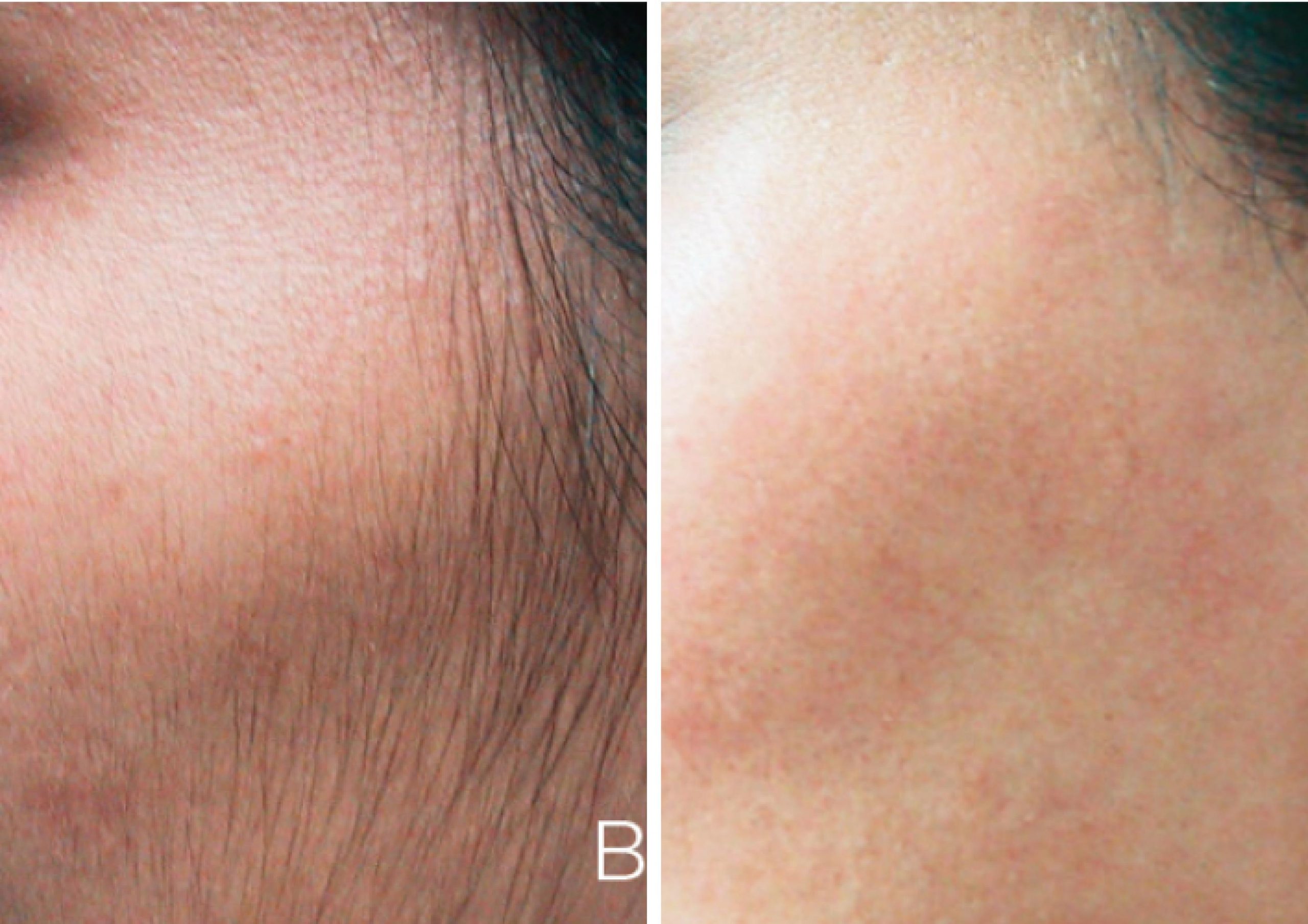 Laser Hair Removal before and after results to cheek area.