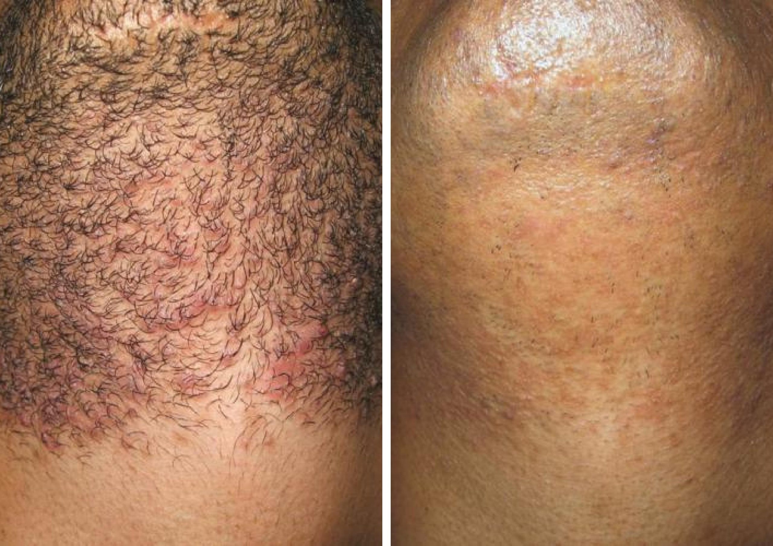 Laser Hair Removal before and after treatment results to chin area.
