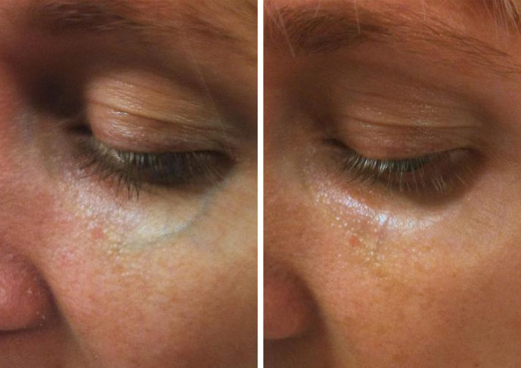 Before and after results of Laser Vein Treatment to the under eye area.