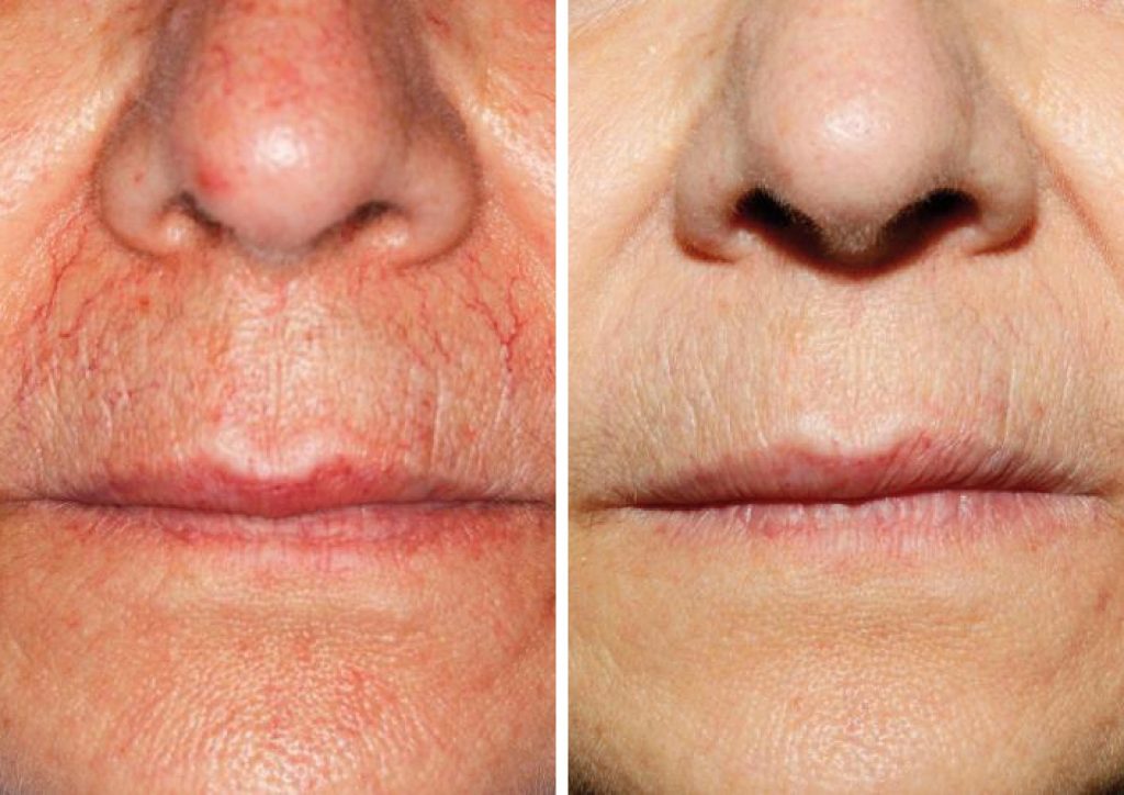 Before and after results of Laser Vein Treatment to the upper lip area.