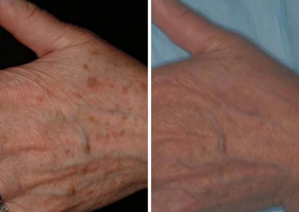 Before and after results of Laser Vein Treatment to the top of the hand.