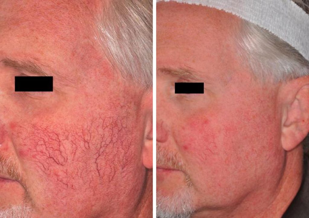 Before and after results of Laser Vein Treatment to the cheek area.