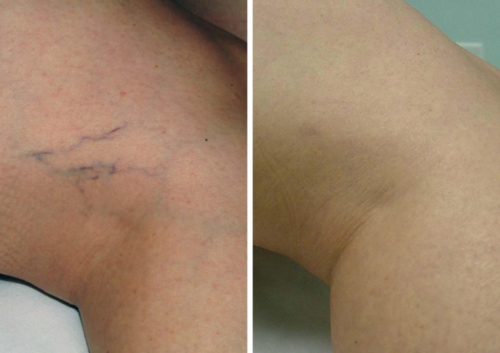 Before and after results of Laser Vein Treatment to the thigh.