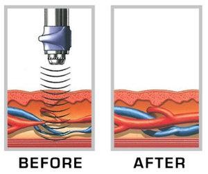 Image showing before and after Gainswave treatment and how it increases bloodflow.