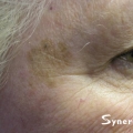A close-up image showing sun spot damage to a woman's cheek area before IPL Photo Facial.