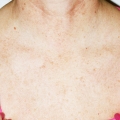 A close-up image showing clear skin, free from sun spots on woman's chest after IPL Photo Facial treatment at Calista Skin and Laser Center.