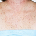 A close-up image showing sun spots to a woman's chest area before IPL Photo Facial.