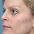 A close-up image showing a woman's clear, sunspot-free cheek after an IPL Photo Facial treatment at Calista Skin and Laser Center.