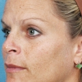 A close-up image showing sun spot damage to a woman's cheek area before IPL Photo Facial.