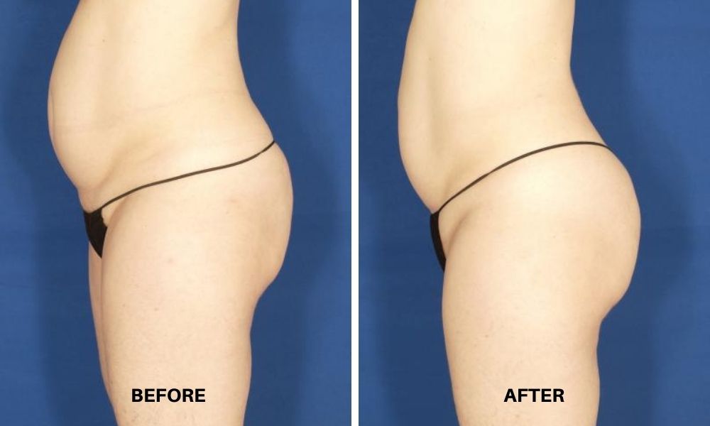 VelaShape, Cellulite Reduction