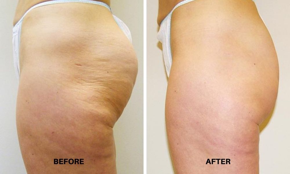 Woman's before and after results to hips and butt from VelaShape.