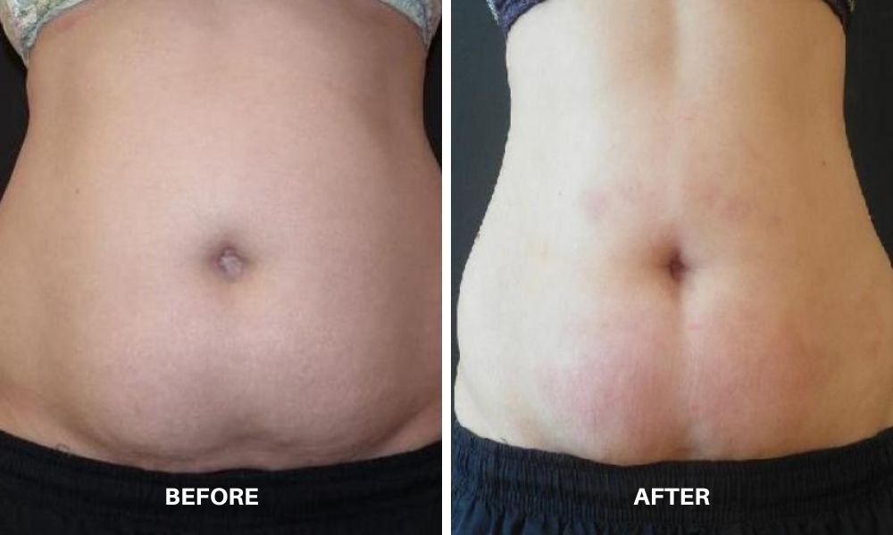 Woman's before and after results to her midsection from VelaShape.