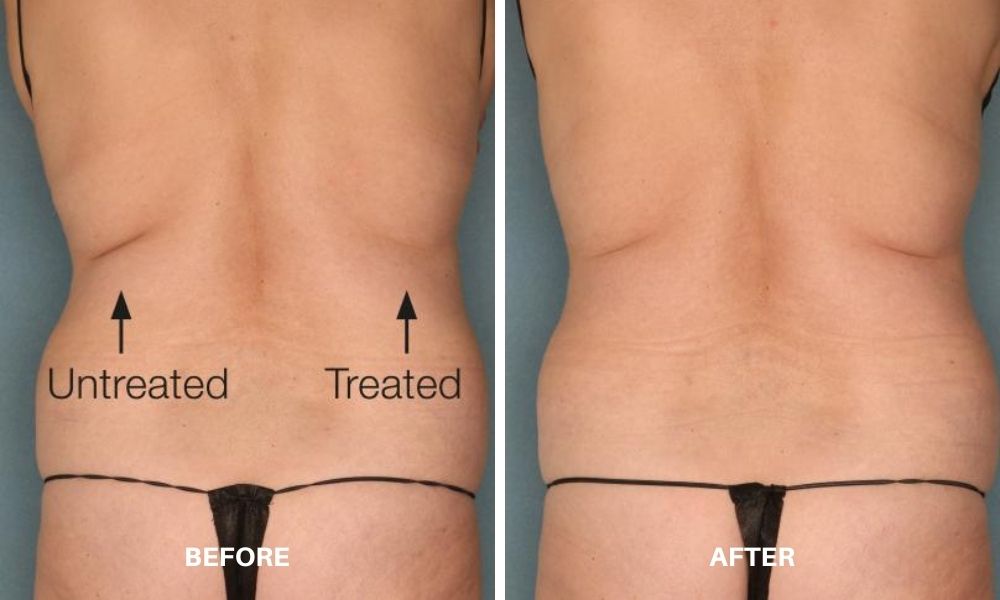 Woman's before and after results to her midsection from VelaShape.