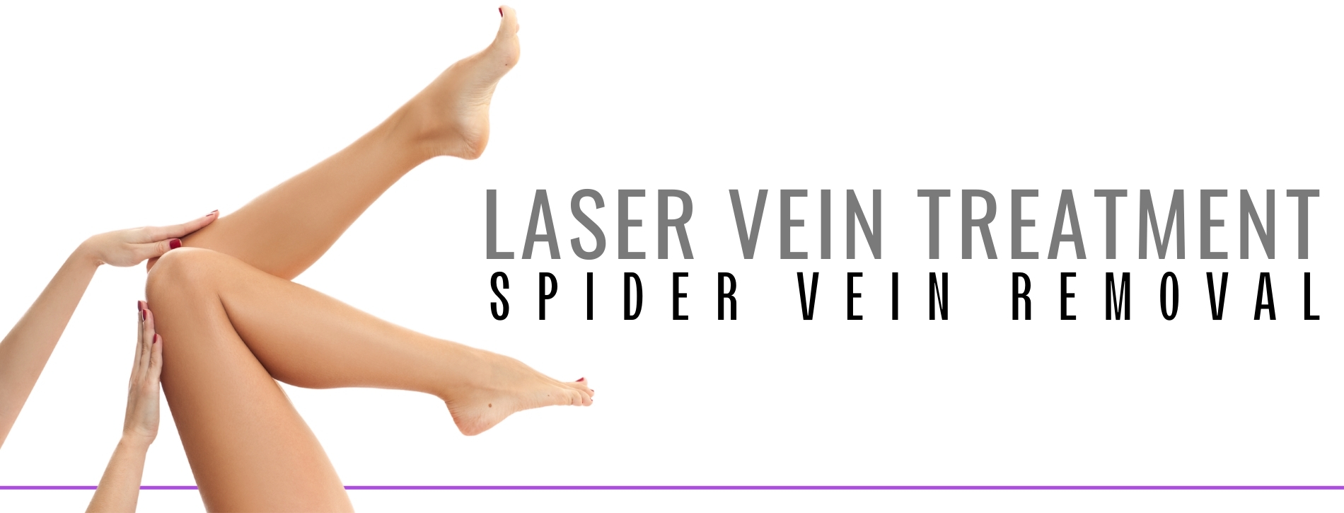 Woman's legs showing results of spider vein removal from laser vein treatment.