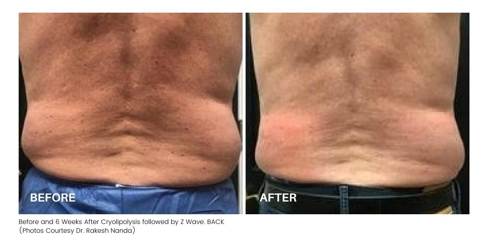 Z-Wave Cellulite Reduction - Calista