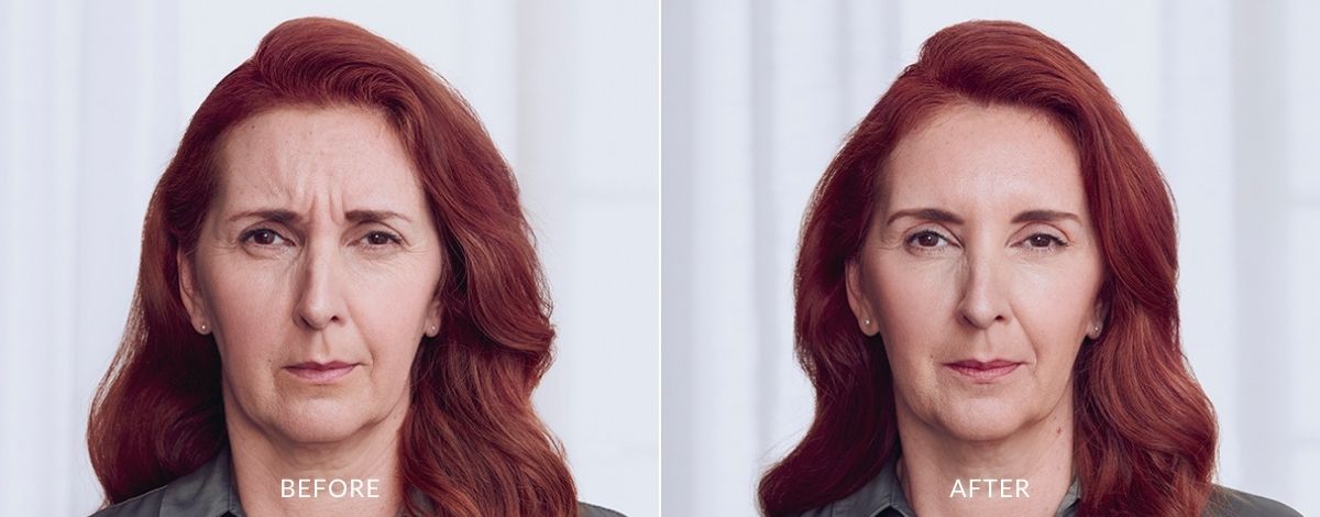 Before and after photos of a middle-aged woman with furrowed brow wrinkles before and smooth, wrinkleless skin after Botox treatment in Colleyville.