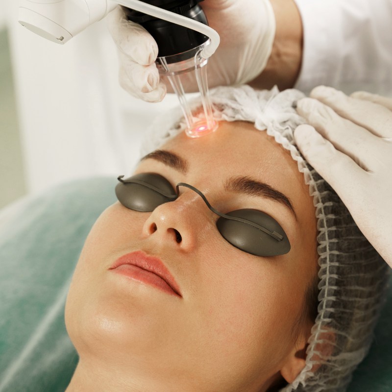 someone getting laser skin resurfacing