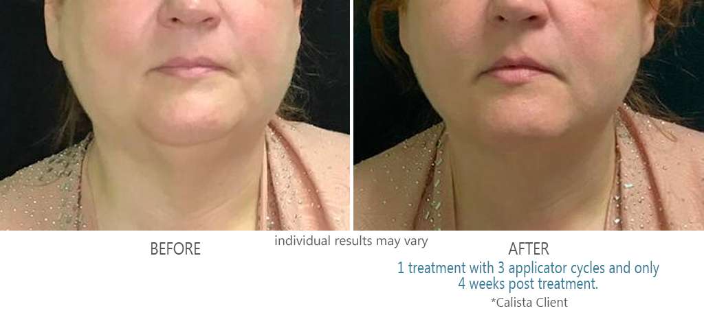 Coolsculpting Elite before and after photos of a woman from treatments at Calista Skin and Laser Center in Colleyville, TX.