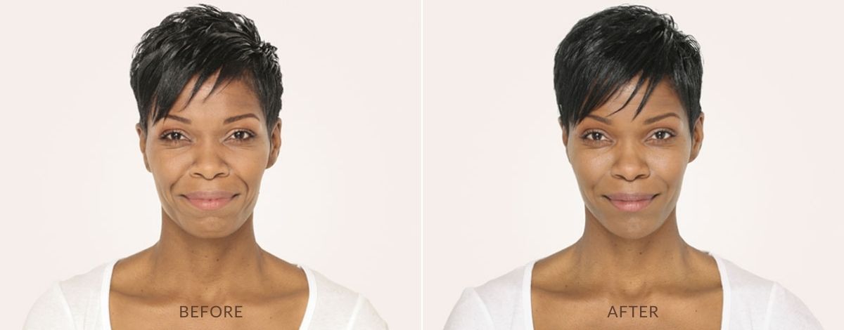radiesse-before-and-after-treatment-1