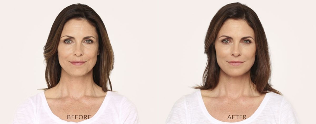 radiesse-before-and-after-treatment-2