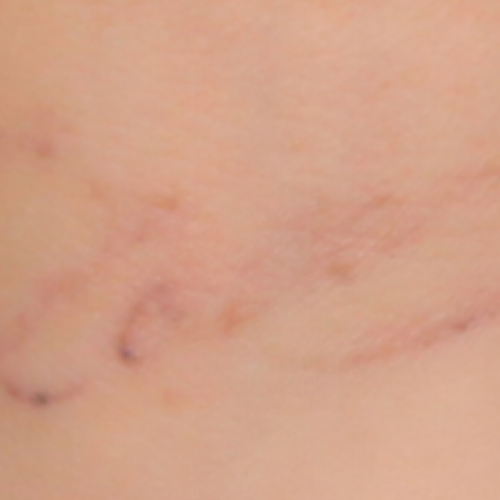 Black ink tattoo, significantly reduced, of the word Love after laser tattoo removal.