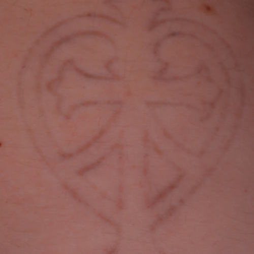 Black ink tattoo, significantly reduced, of a heart and cross after laser tattoo removal.