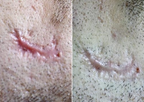 before and after laser skin resurfacing 2